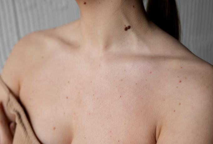 Pimple on Breast: When Should You Worry